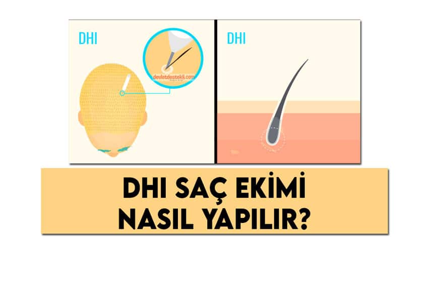 DHI Saç Ekimi Nedir?